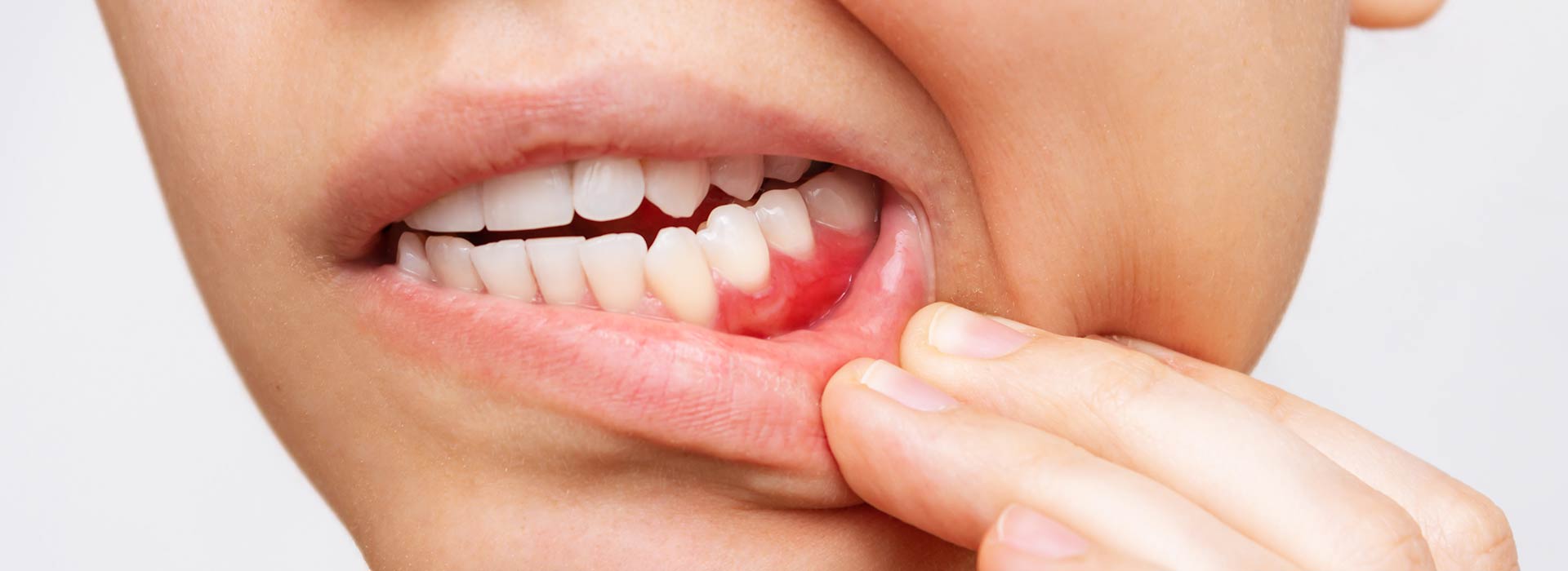 Qué es la periodontitis? Lo que necesitas saber sobre el dolor de muelas