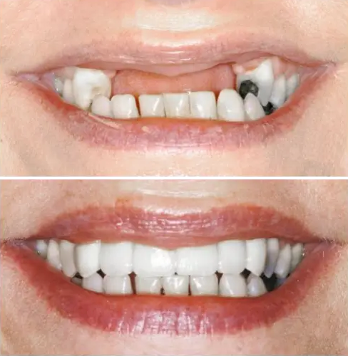 Reemplazo de dientes mediante un puente sostenido por dos o más implantes.