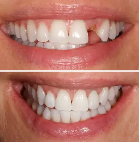 implante-dental-carga-inmediata