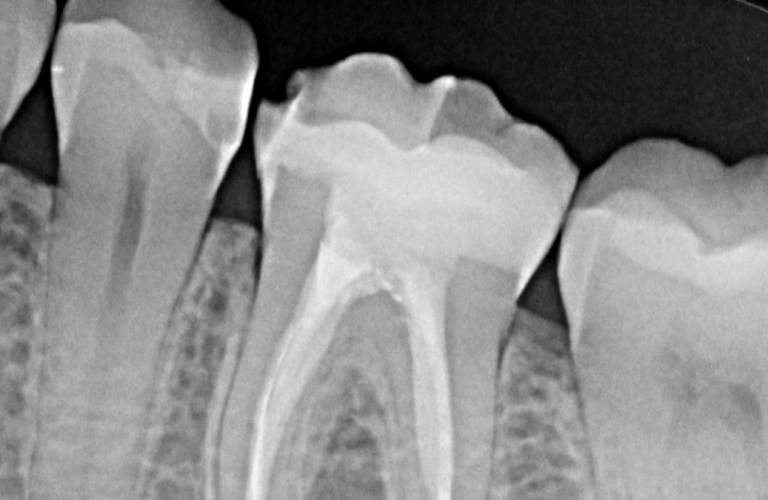 endodoncia-nervio-diente-dentysalud