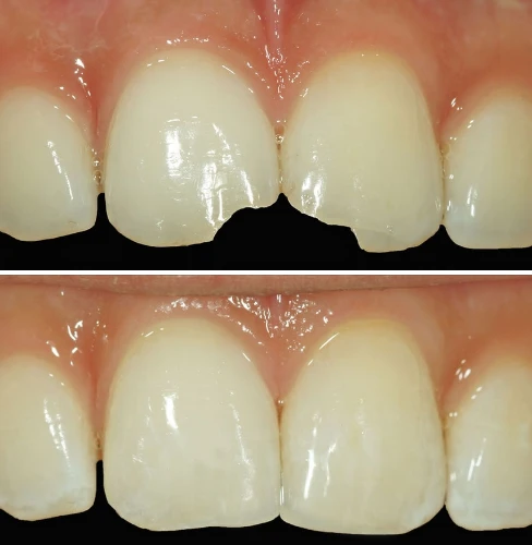diente-roto-solucion-dentistas-dentysalud
