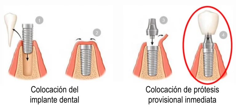 Proceso de colocación de los implantes de carga inmediata