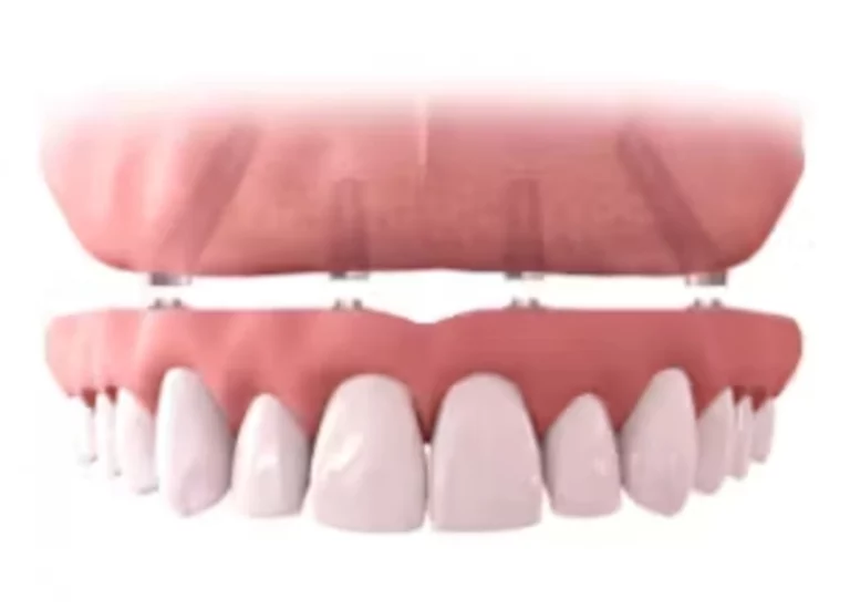 prótesis dental de arcada completa fija, all-on-4 all-on-6