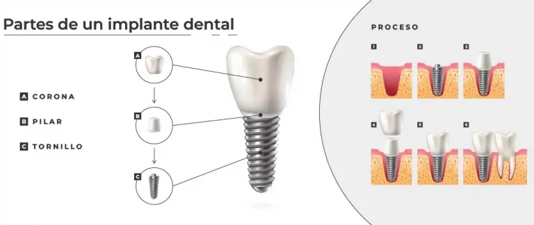 Qué es un implante dental y de qué partes se compone